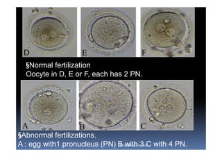 §Abnormal fertilizations.
A : egg with1 pronucleus (PN) B with 3 C with 4 PN.
§Normal fertilization
Oocyte in D, E or F, each has 2 PN.
ABOUBAKR ELNASHAR
 
