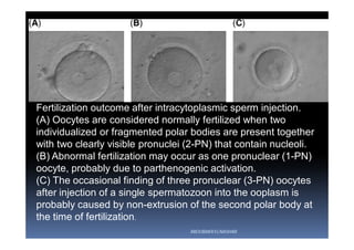 Fertilization outcome after intracytoplasmic sperm injection.
(A) Oocytes are considered normally fertilized when two
individualized or fragmented polar bodies are present together
with two clearly visible pronuclei (2-PN) that contain nucleoli.
(B) Abnormal fertilization may occur as one pronuclear (1-PN)
oocyte, probably due to parthenogenic activation.
(C) The occasional finding of three pronuclear (3-PN) oocytes
after injection of a single spermatozoon into the ooplasm is
probably caused by non-extrusion of the second polar body at
the time of fertilization.
ABOUBAKR ELNASHAR
 
