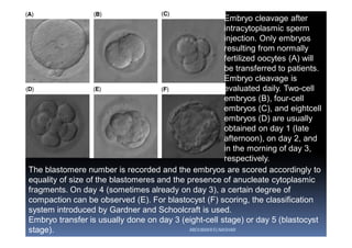 The blastomere number is recorded and the embryos are scored accordingly to
equality of size of the blastomeres and the presence of anucleate cytoplasmic
fragments. On day 4 (sometimes already on day 3), a certain degree of
compaction can be observed (E). For blastocyst (F) scoring, the classification
system introduced by Gardner and Schoolcraft is used.
Embryo transfer is usually done on day 3 (eight-cell stage) or day 5 (blastocyst
stage).
Embryo cleavage after
intracytoplasmic sperm
injection. Only embryos
resulting from normally
fertilized oocytes (A) will
be transferred to patients.
Embryo cleavage is
evaluated daily. Two-cell
embryos (B), four-cell
embryos (C), and eightcell
embryos (D) are usually
obtained on day 1 (late
afternoon), on day 2, and
in the morning of day 3,
respectively.
ABOUBAKR ELNASHAR
 