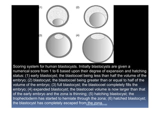 Scoring system for human blastocysts. Initially blastocysts are given a
numerical score from 1 to 6 based upon their degree of expansion and hatching
status: (1) early blastocyst; the blastocoel being less than half the volume of the
embryo; (2) blastocyst; the blastocoel being greater than or equal to half of the
volume of the embryo; (3) full blastocyst; the blastocoel completely fills the
embryo; (4) expanded blastocyst; the blastocoel volume is now larger than that
of the early embryo and the zona is thinning; (5) hatching blastocyst; the
trophectoderm has started to herniate through the zona; (6) hatched blastocyst;
the blastocyst has completely escaped from the zona.ABOUBAKR ELNASHAR
 