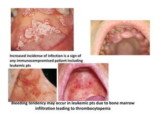 Bleeding tendency may occur in leukemic pts due to bone marrow
infiltration leading to thrombocytopenia
Increased incidense of infection is a sign of
any immunocompromised patient including
leukemic pts
 