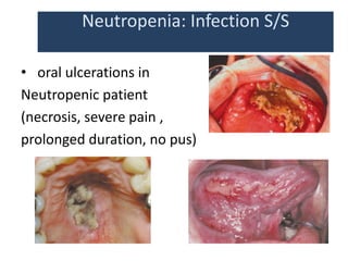 Neutropenia: Infection S/S
• oral ulcerations in
Neutropenic patient
(necrosis, severe pain ,
prolonged duration, no pus)
 