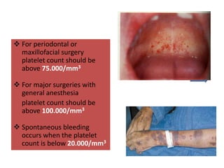  For periodontal or
maxillofacial surgery
platelet count should be
above 75.000/mm3
 For major surgeries with
general anesthesia
platelet count should be
above 100.000/mm3
 Spontaneous bleeding
occurs when the platelet
count is below 20.000/mm3
 
