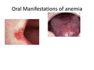 Oral Manifestations of anemia
 