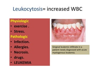 Leukocytosis= increased WBC
Physiologic
• exercise .
• Stress.
Pathologic
• Infection.
• Allergies.
• Necrosis.
• drugs.
• LEUKEMIA
Gingival leukemic infiltrate in a
patient newly diagnosed with acute
myelogenous leukemia.
 