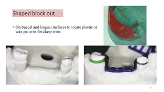 Shaped block out
• On buccal and lingual surfaces to locate plastic or
wax patterns for clasp arms
16
 