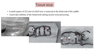 Tissue stop
• Asmall square of 2x2 mm of relief wax is removed at the distal end of the saddle.
• It provides stability of the framework during acrylic resin processing.
19
 