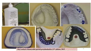 McCracken’s Removable partial prosthodontics.13th edition. 2015 26
 