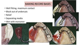 MAKING RECORD BASES
• Well fitting, maximum contact
• Block out of undercuts
• Relief
• Separating media
• Wet with monomer
• polymer
62
 