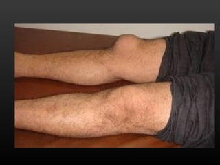 La bursitis (eqcko rp)