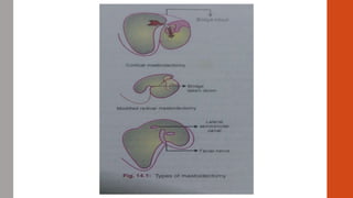 Labyrinthitis | PPTX
