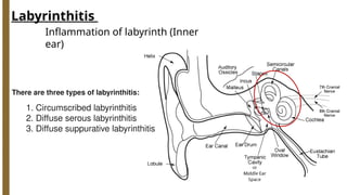 labyrinthitis causes and complications.pptx