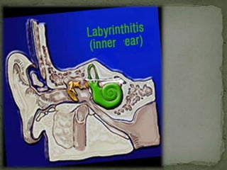 Labyrinthitis the inner ear infection | PPT