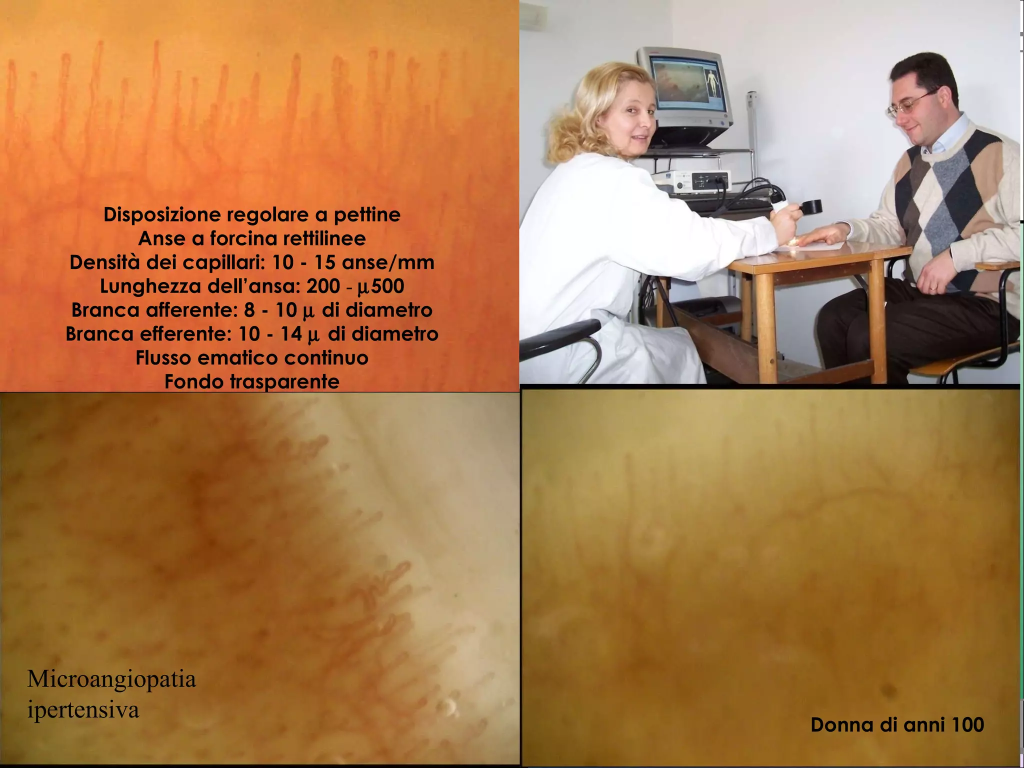 La capillaroscopia nell'artrite reumatoide | PPT