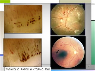 La capillaroscopia nell'artrite reumatoide | PPT