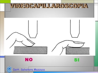 La capillaroscopia nell'artrite reumatoide | PPT