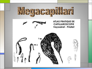 La capillaroscopia nell'artrite reumatoide | PPT