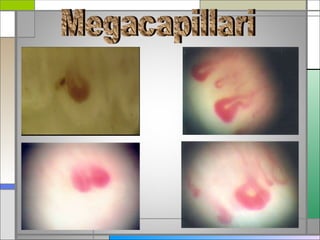 La capillaroscopia nell'artrite reumatoide | PPT