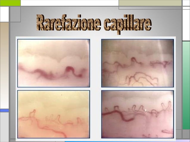 La capillaroscopia nell'artrite reumatoide | PPT
