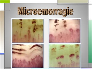 La capillaroscopia nell'artrite reumatoide | PPT