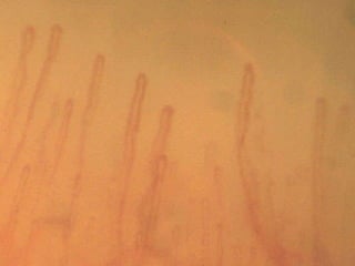 La capillaroscopia nell'artrite reumatoide | PPT