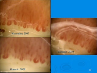 La capillaroscopia può fare la differenza nella diagnosi precoce | PPT