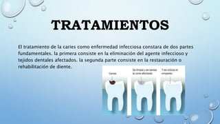 TRATAMIENTOS
El tratamiento de la caries como enfermedad infecciosa constara de dos partes
fundamentales. la primera consiste en la eliminación del agente infeccioso y
tejidos dentales afectados. la segunda parte consiste en la restauración o
rehabilitación de diente.
 