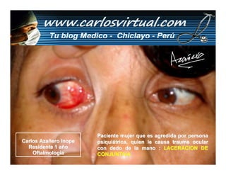 Paciente mujer que es agredida por persona
Carlos Azañero Inope   psiquiátrica, quien le causa trauma ocular
  Residente 1 año      con dedo de la mano : LACERACION DE
    Oftalmología       CONJUNTIVA
 