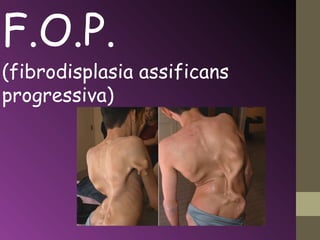 F.O.P.
(fibrodisplasia assificans
progressiva)
 