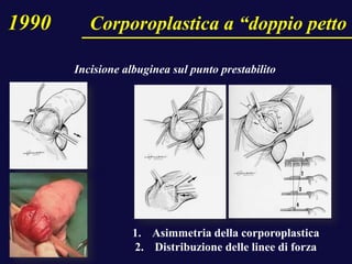 Incisione albuginea sul punto prestabilito
1. Asimmetria della corporoplastica
2. Distribuzione delle linee di forza
1990 Corporoplastica a “doppio petto
 