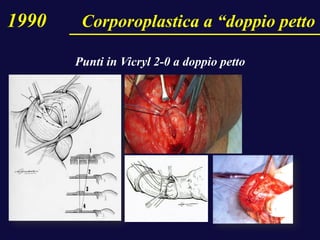 Punti in Vicryl 2-0 a doppio petto
1990 Corporoplastica a “doppio petto
 