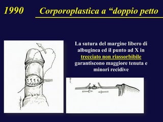 La sutura del margine libero di
albuginea ed il punto ad X in
trecciato non riassorbibile
garantiscono maggiore tenuta e
minori recidive
1990 Corporoplastica a “doppio petto
 