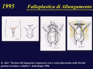 G. Alei: “Sezione del legamento sospensore con o senza lipectomia nelle brevità
peniene assolute e relative”. Andrologia 1996.
1995 Falloplastica di Allungamento
 