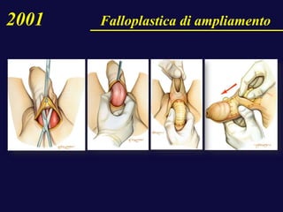 2001 Falloplastica di ampliamento
 