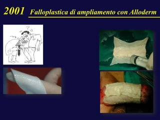 2001 Falloplastica di ampliamento con Alloderm
 