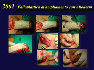 2001 Falloplastica di ampliamento con Alloderm
 