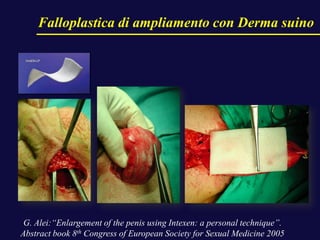 G. Alei:“Enlargement of the penis using Intexen: a personal technique”.
Abstract book 8th Congress of European Society for Sexual Medicine 2005
Falloplastica di ampliamento con Derma suino
 