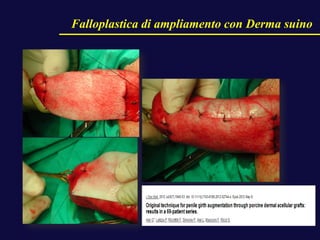 Falloplastica di ampliamento con Derma suino
 