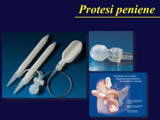Protesi peniene
 