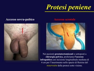 Accesso sovra-pubico Accesso scrotale
Nei pazienti prostatectomizzati o sottoposti a
chirurgia pelvica, preferiamo l’accesso
infrapubico con incisione longitudinale mediana di
4 cm per l’inserimento nello spazio di Retzius del
reservoire della protesi sotto visione.
Protesi peniene
 
