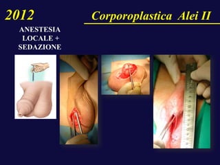 2012 Corporoplastica Alei II
ANESTESIA
LOCALE +
SEDAZIONE
 