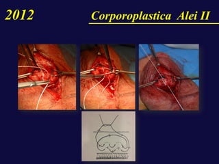 2012 Corporoplastica Alei II
 
