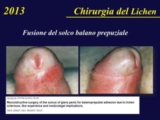 Fusione del solco balano prepuziale
2013 Chirurgia del Lichen
 