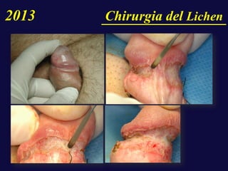 2013 Chirurgia del Lichen
 