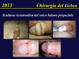 Scultura ricostruttiva del solco balano prepuziale
2013 Chirurgia del Lichen
 