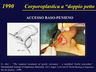 G. Alei : “The surgical treatment of penile curvature : a modified Nesbit procedure” -
International Journal of Impotence Research, Vol.2, Suppl. 2 (Atti del IV World Meeting of Impotence -
Rio De Janeiro) - 1990 .
1990 Corporoplastica a “doppio petto
ACCESSO BASO-PENIENO
 