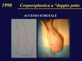 1990 Corporoplastica a “doppio petto
ACCESSO SCROTALE
 