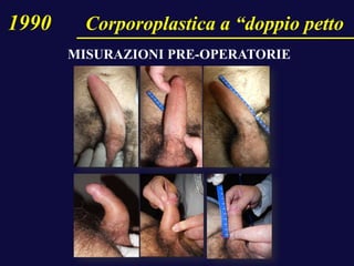 1990 Corporoplastica a “doppio petto
MISURAZIONI PRE-OPERATORIE
 