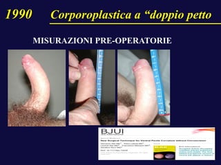 1990 Corporoplastica a “doppio petto
MISURAZIONI PRE-OPERATORIE
 