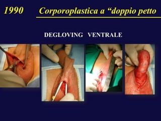 1990 Corporoplastica a “doppio petto
DEGLOVING VENTRALE
 
